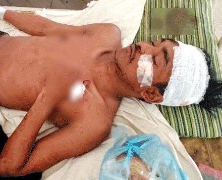 কাঁঠালিয়ায় দাখিল পরীক্ষার্থীকে কুপিয়ে জখম: হাসপাতালে ভর্তি