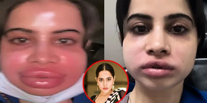 চেহারা নিয়ে ভাইরাল উরফি, মুখ-ঠোঁট ফুলে ঢোল—উদ্বিগ্ন নেটদুনিয়া